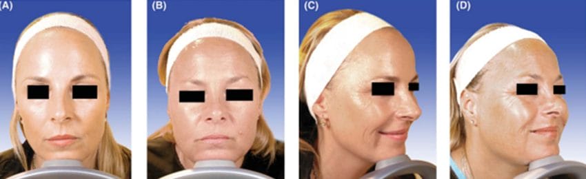 Long-Term Effects of Anti-Wrinkle treatments on Facial Lines: A 19-Year Experience of Identical Twins